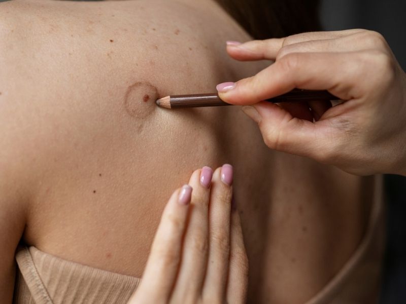 benlerin-dermoskopi-ile-takibi