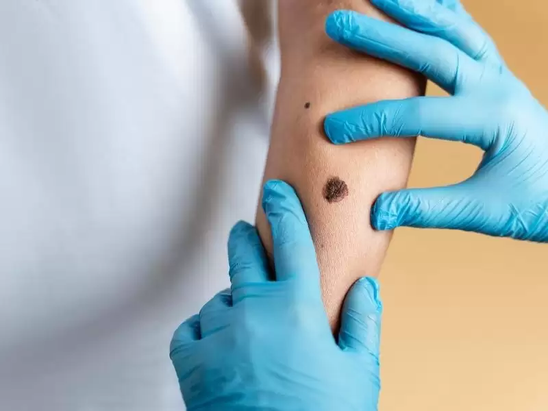 benler-et-benler-cilt-kanserleri