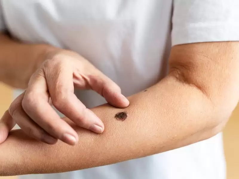 benler-et-benleri-cilt-kanserleri