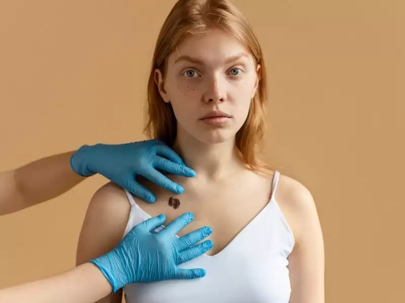 benler-et-beni-cilt-kanserleri