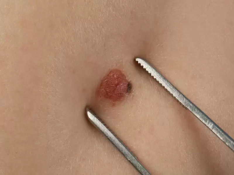 elektrokoter-sigil-yakilmasi