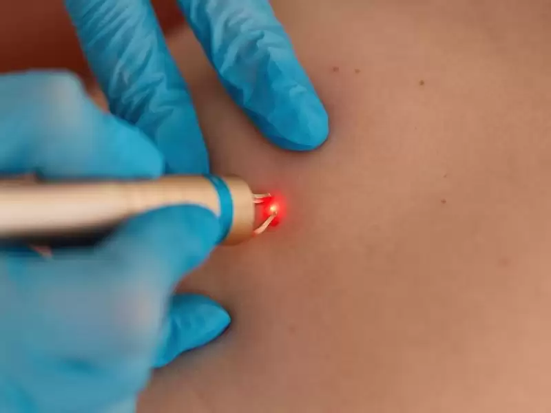 kriyoterapi-sigil-dondurulmasi