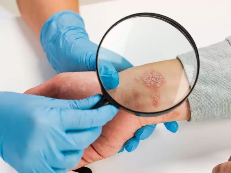 sedef-vitiligo-liken