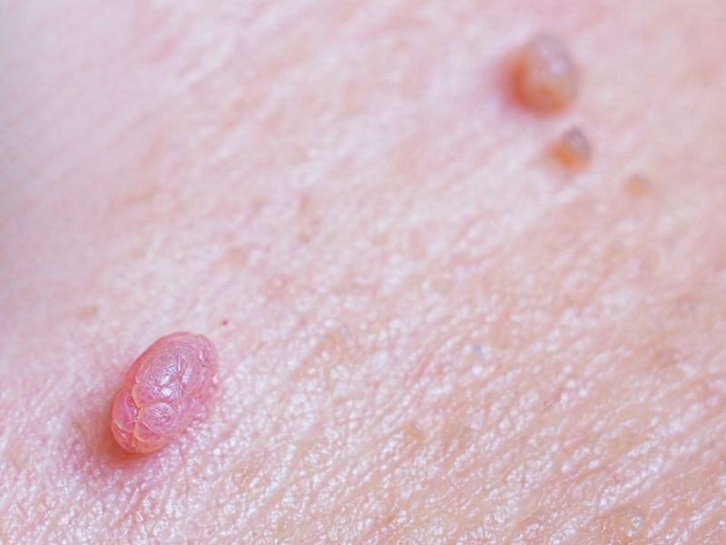 cinsel-yolla-gecen-hastaliklar