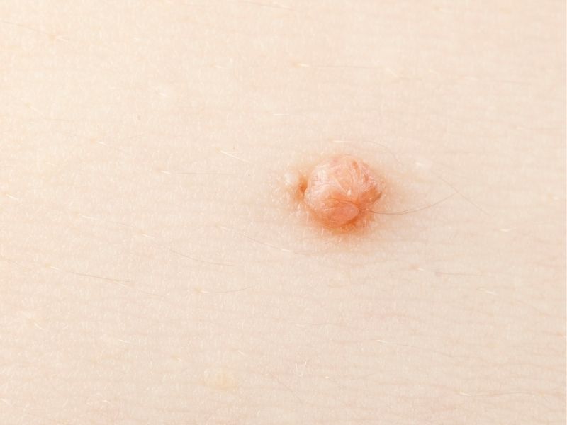 hpv-tedavi-yontemleri